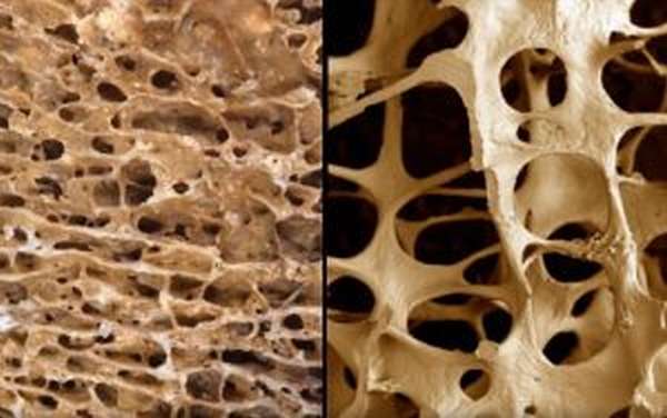 Денситометрия и остеопороз